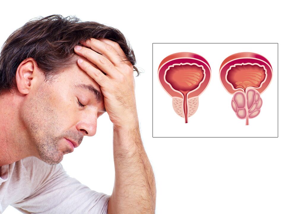 adenoma de próstata com impotência
